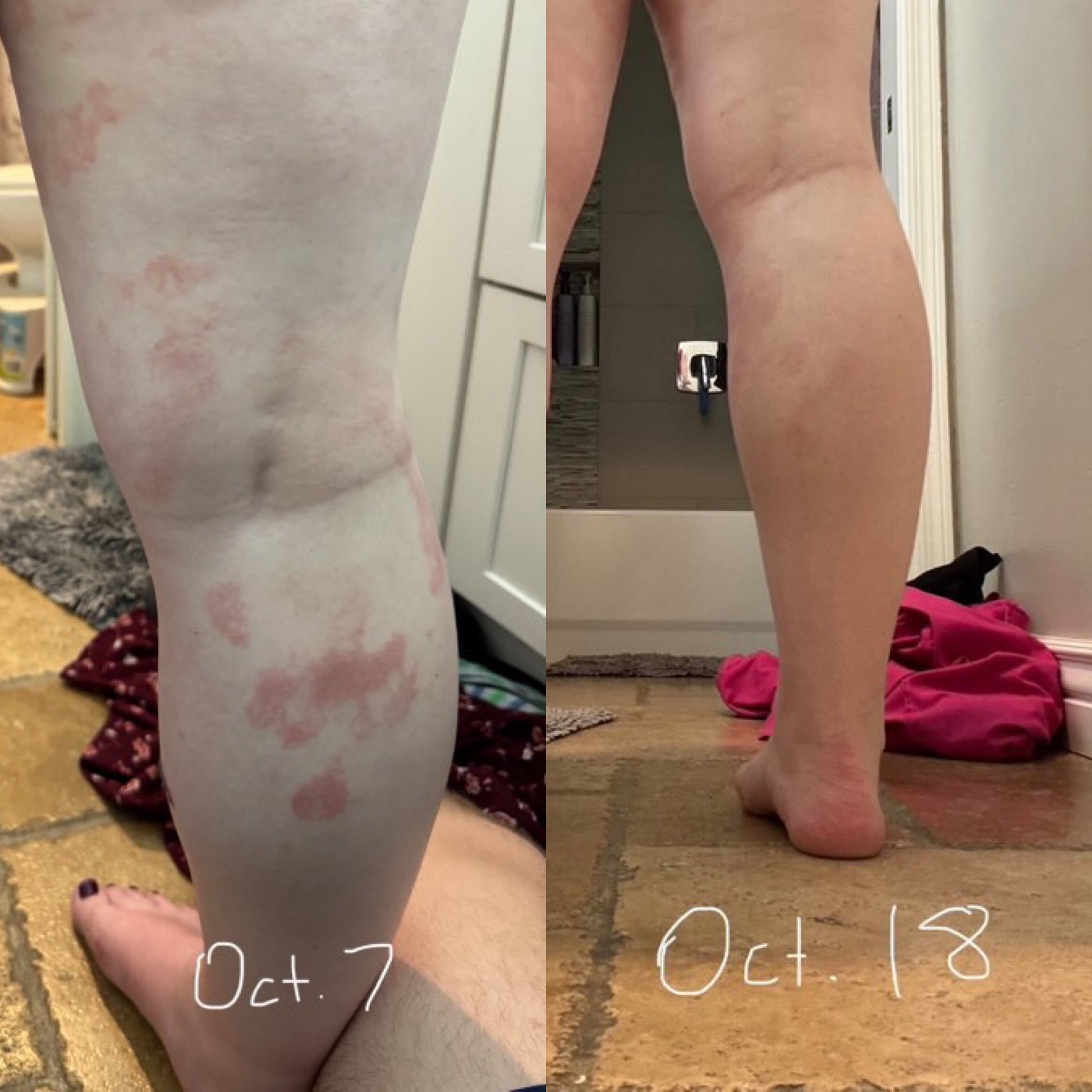 Helps eczema, help psoriasis, natural skincare, hydrating, organic skin care
All Natural skincare, extra hydration, organic skincare , moisturizer, Natural skincare, skin hydration, helps rosacea, helps acne, reduces wrinkles, reduces fine lines, organic skincare, Beef Tallow Skincare