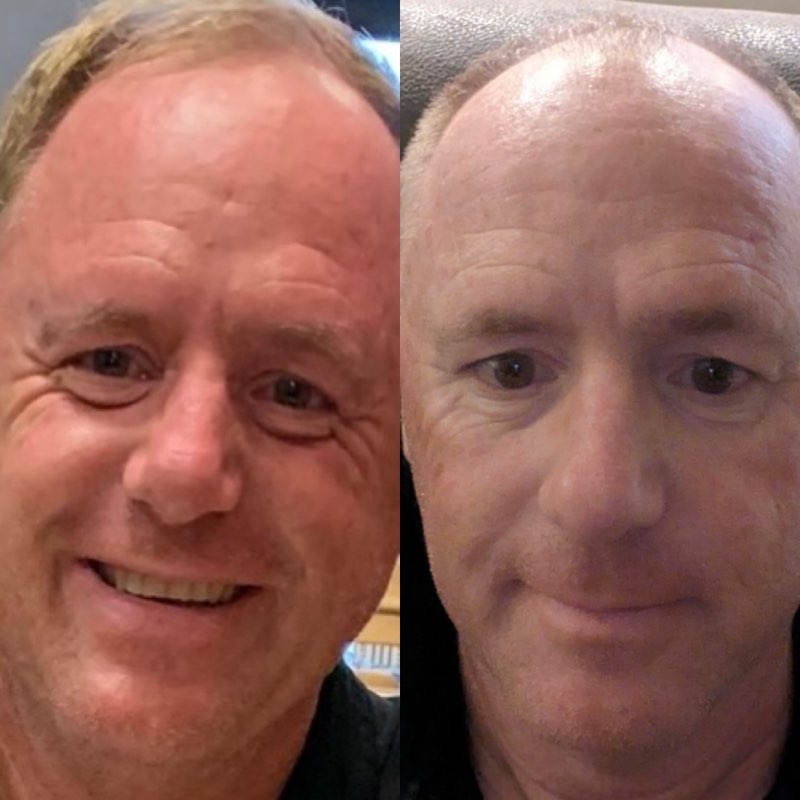 Natural skincare, helps rosacea, helps reduce redness, Natural skincare, skin hydration, helps acne, reduces wrinkles, reduces fine lines, organic skincare, Beef Tallow Skincare